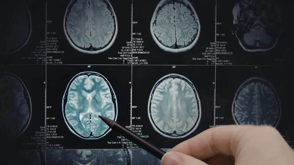 Traumatic brain injury diagnosis and treatment concept in Florida