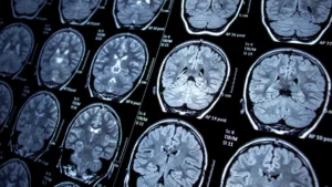 traumatic-brain-injury-lawyer-sarasota